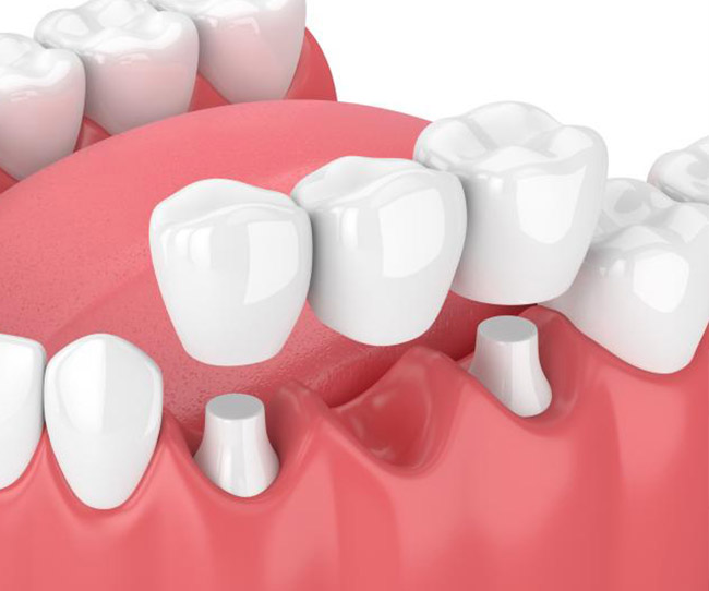 vancouverharbourdental_services_dental_bridge https://vancouverharbourdental.com/wp-content/uploads/2023/09/vancouverharbourdental_services_dental_bridge-640x534.jpg